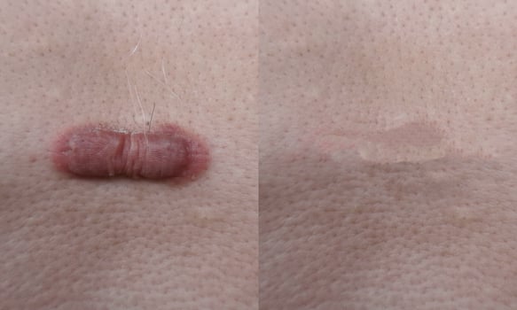 Keloid scars before and after treatment. photo