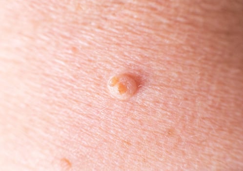 large wart on the skin of a person, background, macro, dermatology photo