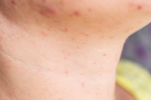 Red acne and a rash on a girl's face and neck, macro, hormone photo