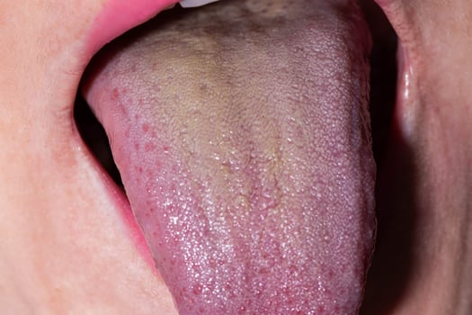 Close-up of a yellow coating on the girl's tongue. Sign of diseases of the gastrointestinal tract, liver and gallbladder disease photo