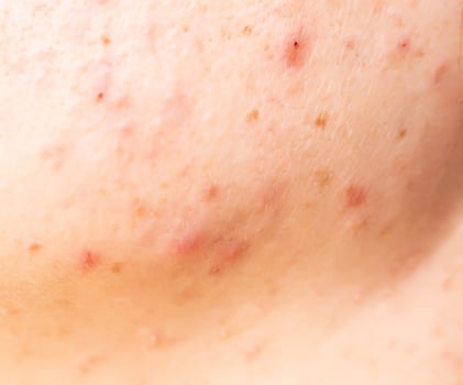 Red acne on the girl's face, background, macro photo
