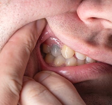 Black tooth in the mouth of a man after nerve depulpation. Dead darkened tooth, macro photo
