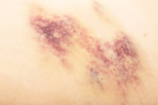 Bruises on the patient's body after injections, bruises under the skin, medical photo