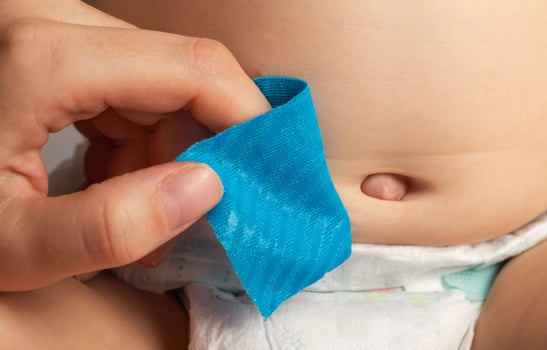 Mother's hands seal the umbilical hernia of a newborn child with a blue plaster. Treatment of an enlarged umbilical ring without surgery, close-up photo