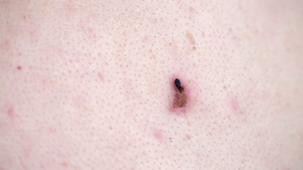 removal of papilloma on human skin, cauterization of warts with a laser. Copy space for text, dermatology photo