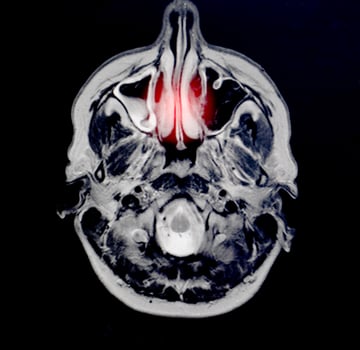 Magnetic resonance imaging of a patient with bad nose breathing, nasal congestion. The concept of hyperplasia of the ethmoid cell mucosa, otolaryngology photo