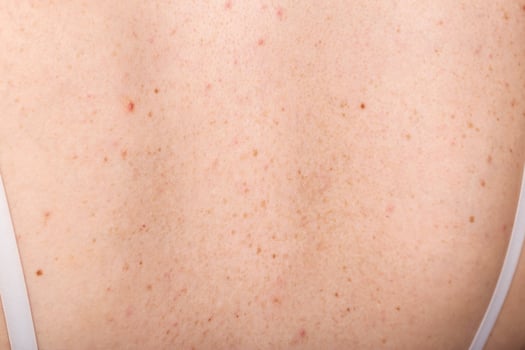 Pigmented spots and pimples on the skin of the girl's back. Dermatology and allergy concept, close-up photo