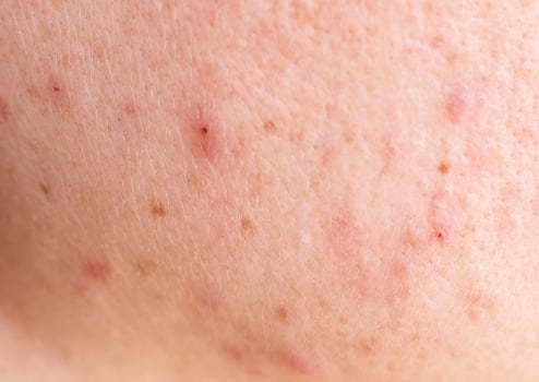 Red acne on the girl's face, background, macro photo