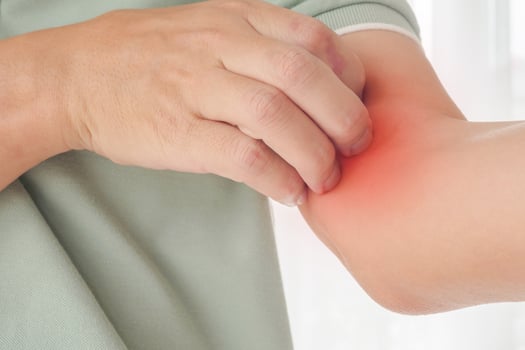 Young asian man itching and scratching on arm from itchy dry skin eczema dermatitis photo