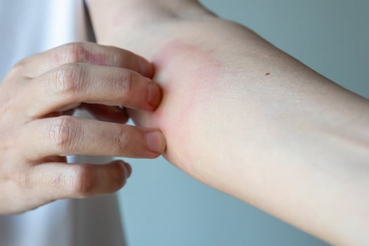 Young asian man itching and scratching on arm from allergic itchy dry skin eczema dermatitis insect bites photo