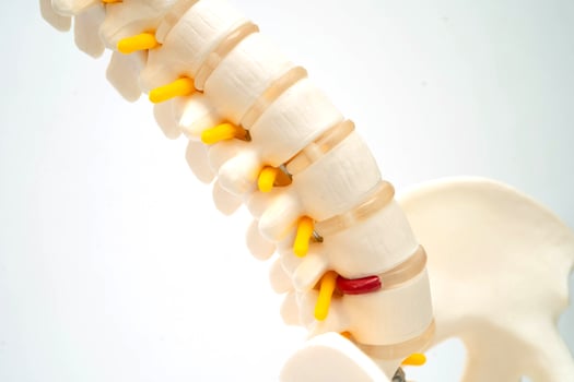 Spinal nerve and bone, Lumbar spine displaced herniated disc fragment, Model for treatment medical in the orthopedic department. photo