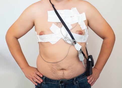An obese man undergoes a Holter monitoring of the heart. A modern method for studying the heart in caodiology. Arrhythmia and ischemic disease. Medic photo
