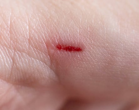 Deep wound, scratch on the finger, background, macro, blood photo