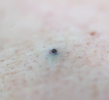 Black pimple acne on human skin, background. Acne and acne treatment, cosmetology, hygiene photo