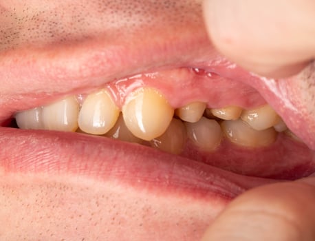 Ground prepared teeth before installing a porcelain fused-to-metal crown for decayed teeth. Prosthetics in dentistry, macro photo