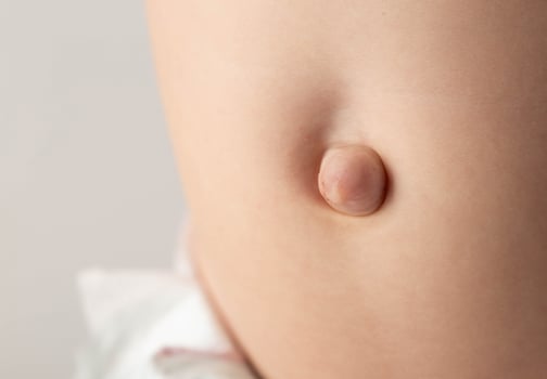 Umbilical hernia in a newborn baby on the stomach. Treatment of umbilical hernias in children without surgery, medical. Close-up photo