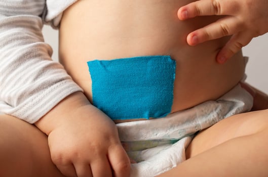 The navel is sealed with a blue plaster on the stomach of a child. Treatment of umbilical hernia in newborns, close-up photo