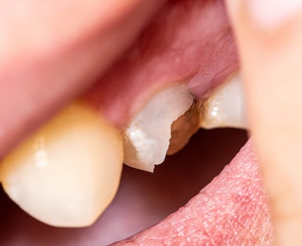 Chipped piece of a dead pulp tooth. Restoration of a damaged tooth in dentistry, defect in tooth enamel, thin tooth walls. Macro photo