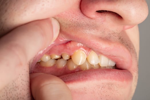 Ground prepared teeth before installing a porcelain fused-to-metal crown for decayed teeth. Prosthetics in dentistry, macro photo