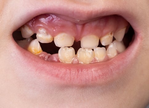 Mouth and smile of a child without one tooth. Loss of milk teeth in children, close-up photo