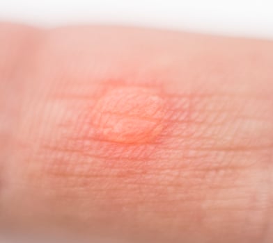 Red wet corn dropsy on the finger on the hand, macro, callus on the skin, inflammation photo