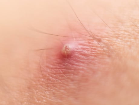 Big red boiling pimple furuncle on the skin, macro, inflamed boil, dermatology photo