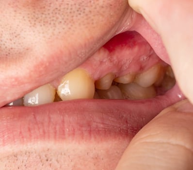 Dissection of decayed teeth for the installation of a dental crown in dental orthopedics. Tooth enamel grinding, dental prosthetics, close-up photo