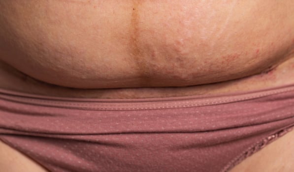 The seam on the abdomen of a woman after a caesarean section. Recovery of the female body after the birth of a child, complications. Close-up, postponed photo