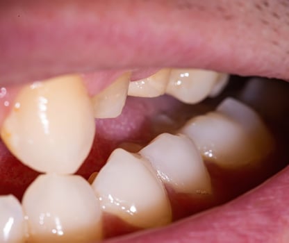 Grind teeth under a metal-ceramic crown in a man's mouth. Dental prosthetics in dental orthopedics, macro photo