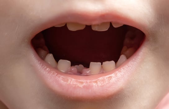The open mouth of a child without one tooth. Loss of milk teeth. Close-up, deciduous teeth photo