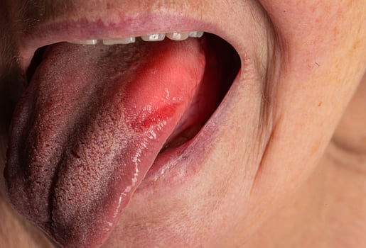 Inflammatory disease in the tongue. Red spot, glossitis. Hygiene of the tongue, close-up. Symptom of vitamin deficiency and bacteria photo