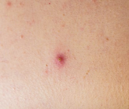 Red pimple on face macro, abscess and acne photo