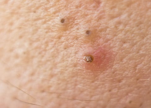 Black dots on face and pimples macro, comedo photo