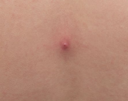 Big red pimple abscess on the skin, close-up, pimple inflammation on the skin, copy space, infection photo