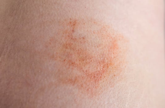 Bruise and subcutaneous lump on the patient s skin after injections. Post-injection infiltrates, close-up photo