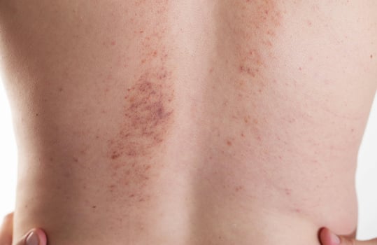 Redness and irritation on the skin of a man s back after a massage. Pimples and red spots with bruises on the skin, close-up photo