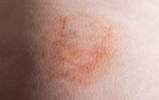 Bruise and subcutaneous lump on the patient s skin after injections. Post-injection infiltrates, close-up photo