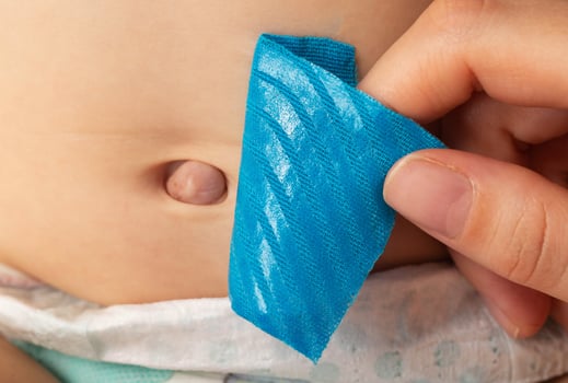 Mother's hands seal the umbilical hernia of a newborn child with a blue plaster. Treatment of an enlarged umbilical ring without surgery, close-up photo