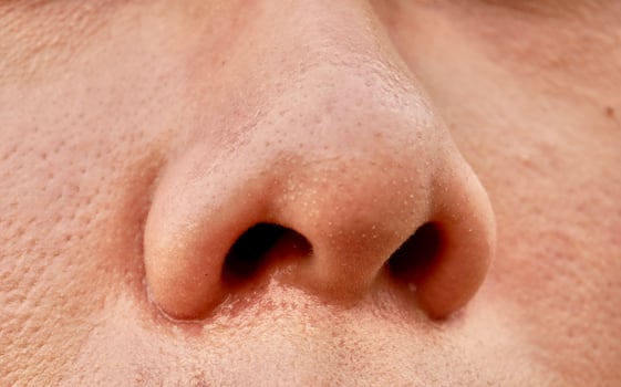 Close up human nose with oily skin and blackheads comedo on pores isolated on horizontal ratio bare face texture background. photo
