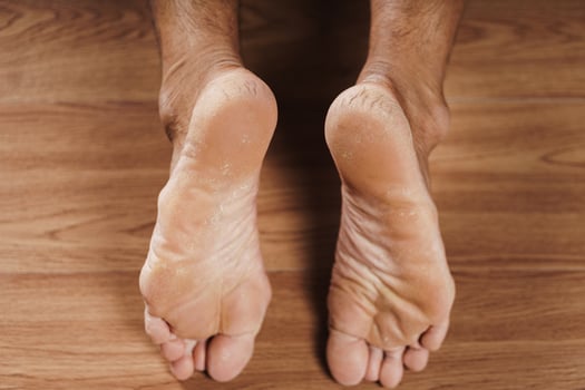 A pair of feet with dry cracked hard heel skin on the floor. healthcare and medical concept. photo