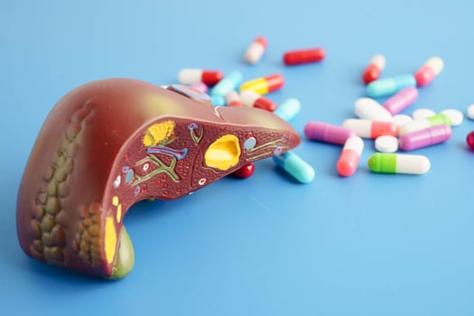 Liver model with pill drug treatment, Cirrhosis, Liver cancer, fatty liver. photo