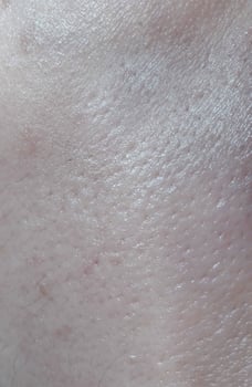 Uneven skin texture.Skin with large pores photo