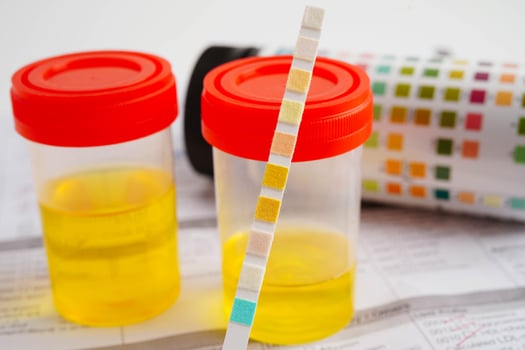 Urinalysis, urine cup with reagent strip pH paper test and comparison chart in laboratory. photo