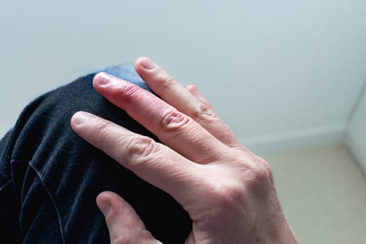 Mallet finger healing after splint removal from middle finger following joint trauma photo