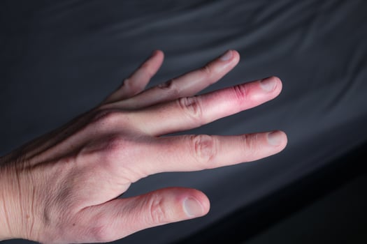 Mallet finger healing after splint removal from middle finger following joint trauma photo