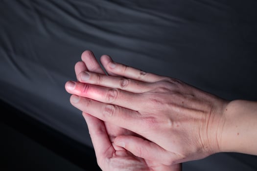 Mallet finger healing after splint removal from middle finger following joint trauma photo