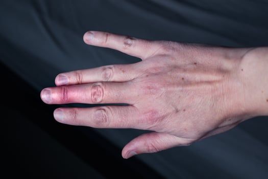 Mallet finger healing after splint removal from middle finger following joint trauma photo