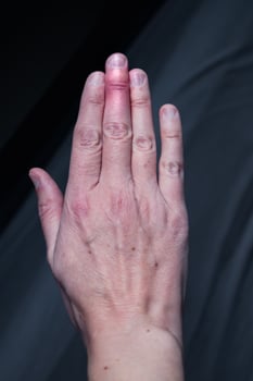 Mallet finger healing after splint removal from middle finger following joint trauma photo
