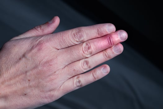 Mallet finger healing after splint removal from middle finger following joint trauma photo