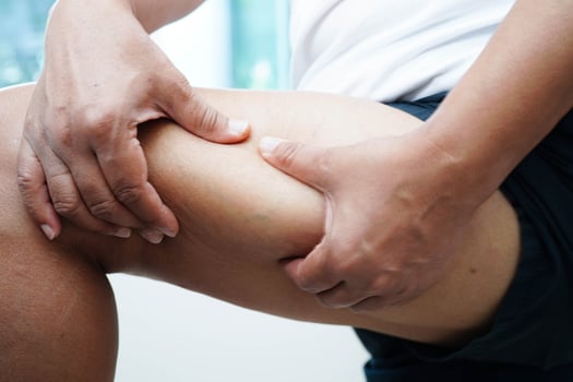 Asian woman with cellulite on leg skin fat, overweight problem. photo
